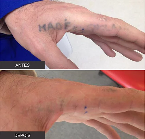 antes-e-depois-inkie-tatuagem-na-mao